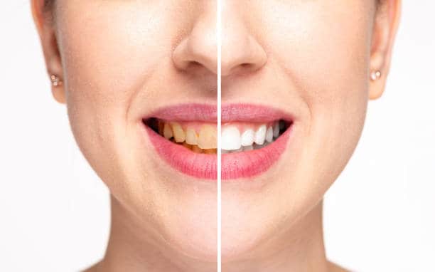 Teeth Whitening Milton Keynes Hertfordshire