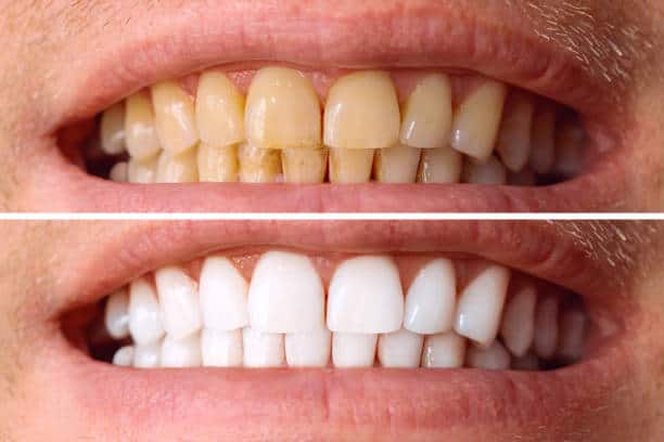 Laser White For Ever Bright – Get a Brighter, Whiter Smile with LA Teeth Whitening Hertfordshire