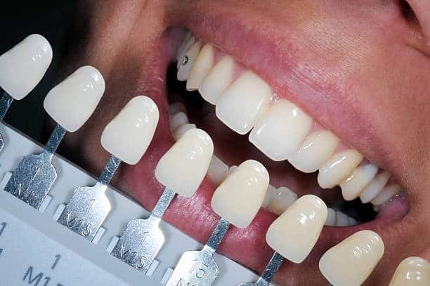 Get Natural and Stunning Smile with Teeth Whitening Results from LA Teeth Whitening Hertfordshire