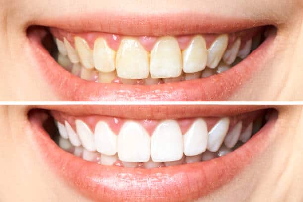 Achieve a Dazzling Smile for Your Special Day: A Guide to Wedding Teeth Whitening Hertfordshire