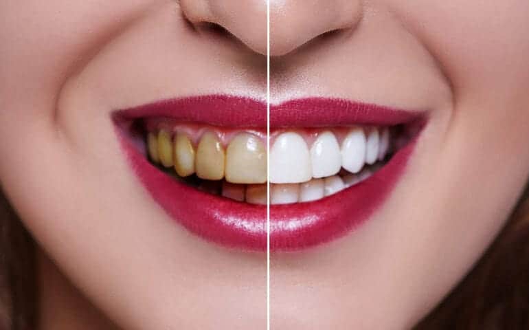 Teeth Whitening Ascot Windsor Hertfordshire