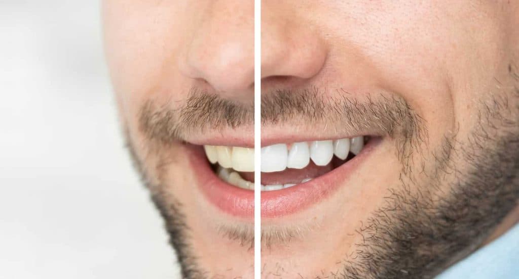 Teeth Whitening Bedfordshire Hertfordshire