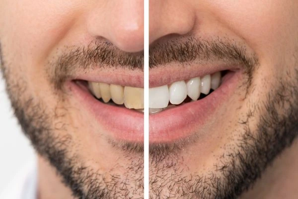 A whiter smile in just 1 hour with Blue light teeth whitening Hertfordshire! Hertfordshire